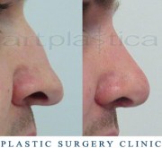Nose correction with transplantation