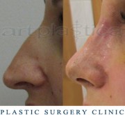 Nose correction -10 days after the operation - Beauty Group - Artplastica
