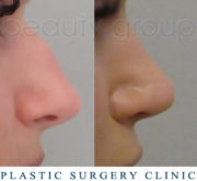 Nose correction - Beauty Group