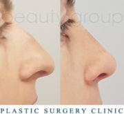 Nose correction (Rhinoplasty)