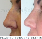 Nose correction (Rhinoplasty)