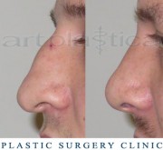 Nose correction (Rhinoplasty)