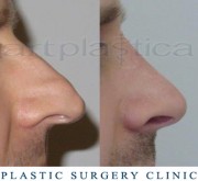 Nose correction (Rhinoplasty)