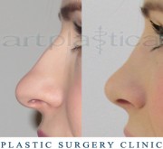 Nose correction (Rhinoplasty) 