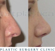 Nose correction (Rhinoplasty) 