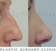 Nose correction (Rhinoplasty)