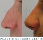 Nose correction (Rhinoplasty) 