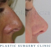 Nose correction (Rhinoplasty) 