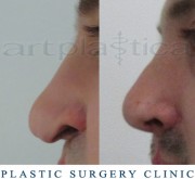 Nose correction (Rhinoplasty) 