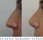 Nose correction (Rhinoplasty) 