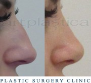 Nose correction (Rhinoplasty) 