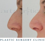 Nose correction (Rhinoplasty) 