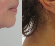 Chin & Neck correction gallery