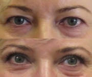 After and before eyelid correction photo