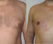 Before and After photo male breast reduction - gynecomastia