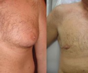 Before and After photo male breast reduction - gynecomastia