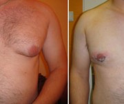 Before and After photo male breast reduction - gynecomastia 