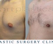 Before and After photo - male breast reduction - gynecomastia - Beauty Group
