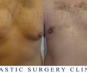 Before and After photo male breast reduction - gynecomastia 