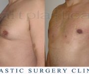 photo male breast reduction - gynecomastia - one day after surgery