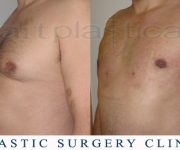 Before and After photo - male breast reduction - gynecomastia - Beauty Group