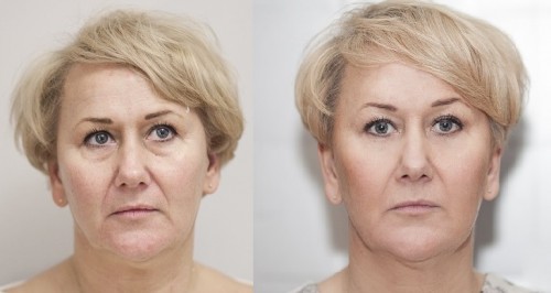 Aesthetic Medicine before after. Juvederm.
