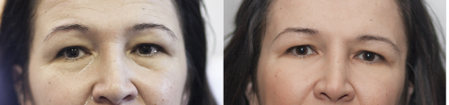 aesthetic-surgery-pictures-juvederm-1