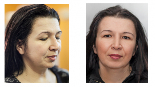 Aesthetic Surgery Pictures. Juvederm