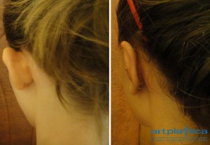 Correction of prominent ears - before and after photos