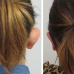 Correction of prominent ears - before and after photos
