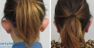 Correction of prominent ears - before and after photos