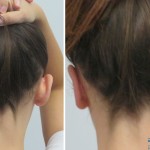 Correction of prominent ears - before and after photos
