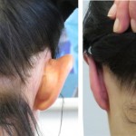 Correction of prominent ears - before and after photos