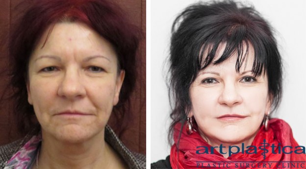 Face lift and upper eyelid