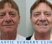 Augusto Mochini - Beauty Group - Face and neck lift 