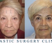 Beauty Group - Artplastica - Face lift and eyelid correction