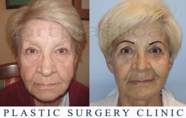 Beauty Group - Artplastica - Face lift and eyelid correction