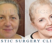 Beauty Group - Artplastica - Face lift and upper eyelid correction