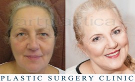 Beauty Group - Artplastica - Face lift and upper eyelid correction