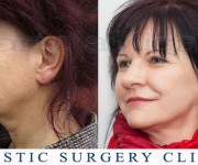 Beauty Group - Artplastica - Face lift and upper eyelid correction