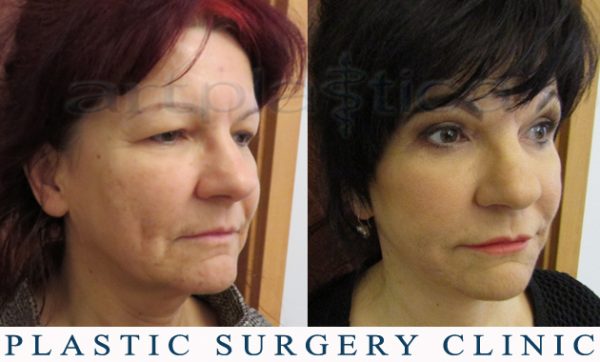 Beauty Group - Artplastica - Face lift and upper eyelid correction