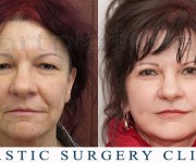 Beauty Group - Artplastica - Face lift and upper eyelid correction