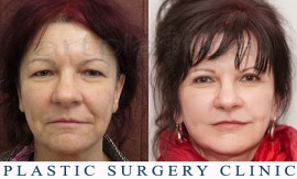 Beauty Group - Artplastica - Face lift and upper eyelid correction