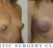 Breast enlargement, nipple correction