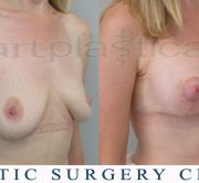 Breast enlargement with mastopexy - 3 weeks after surgery