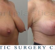 Breast enlargement with mastopexy