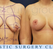 Breast enlargement with mastopexy - Beauty Group