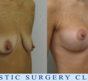Breast enlargement with mastopexy - 2 months after surgery - Beauty Group