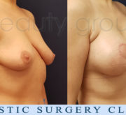 Breast enlargement with mastopexy - Beauty Group