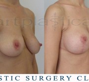 Breast enlargement with mastopexy - Beauty Group - Artplastica